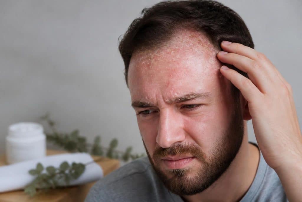découvrez les causes, symptômes et traitements efficaces de la croûte de lait chez l'adulte pour mieux comprendre et soulager cette affection cutanée.